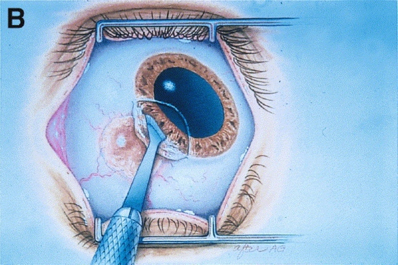 Chẩn đoán u kết mạc qua sinh thiết tổ chức kết mạc 4