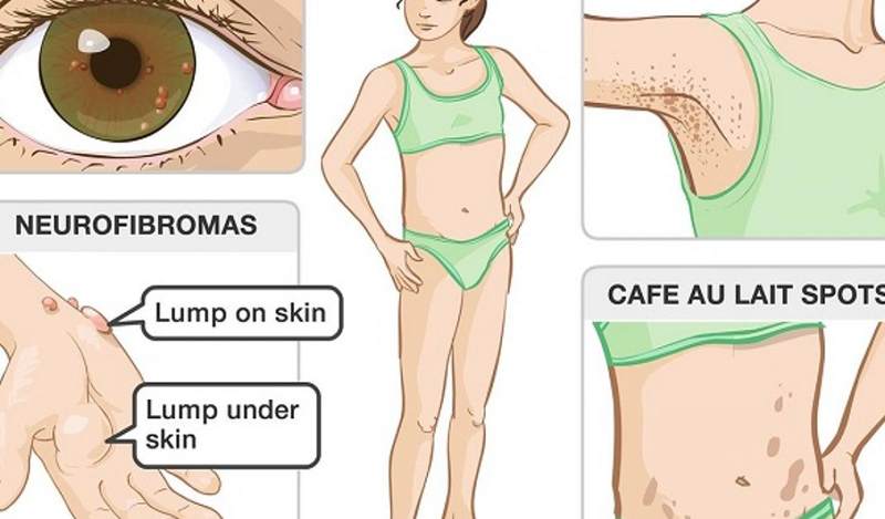 Các dấu hiệu chẩn đoán bận u sợi thần kinh