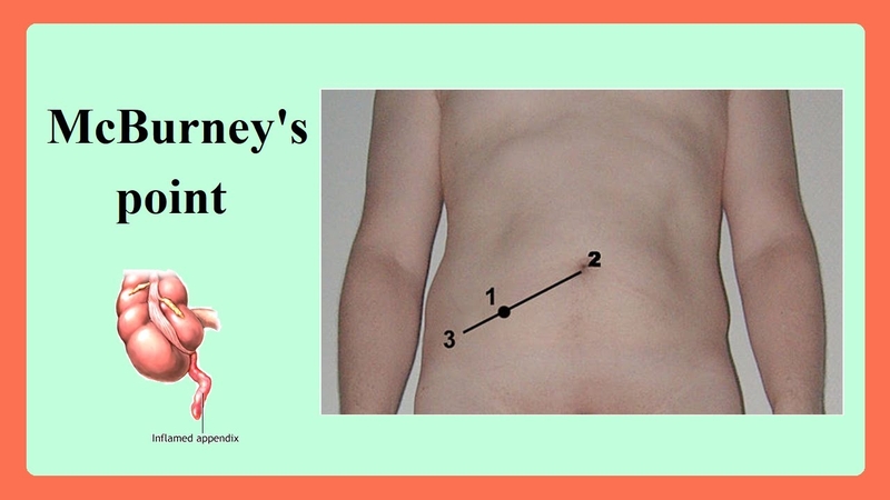 Chẩn đoán viêm ruột thừa bằng cách nào? 5