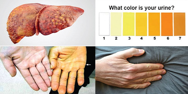 Chẩn đoán xơ gan và cách điều trị hiệu quả.1