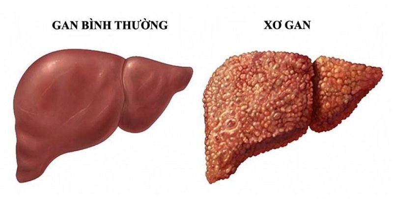 Chẩn đoán xơ gan và cách điều trị hiệu quả.3