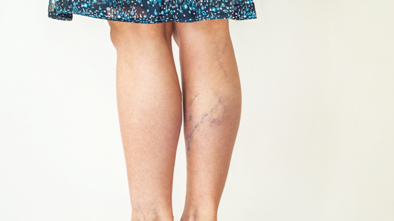 Chân nổi gân xanh có nguy hiểm không? Phương pháp điều trị 2