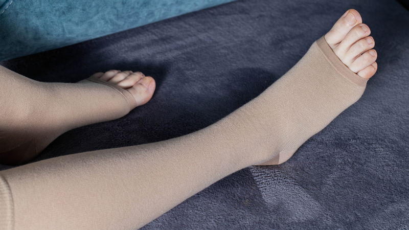 Chân nổi gân xanh có nguy hiểm không? Phương pháp điều trị 3