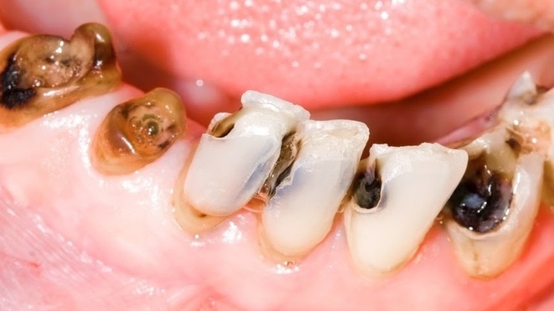 Chân răng bị mục: Nguyên nhân và các phương pháp điều trị 2