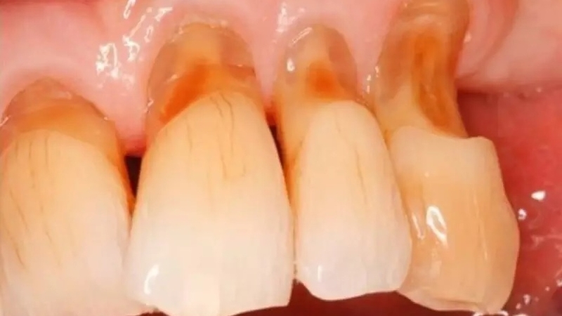 Chân răng bị mục: Nguyên nhân và các phương pháp điều trị 1