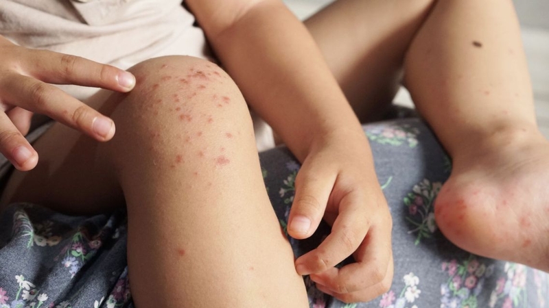 Chân tay miệng kiêng gì là thông tin cha mẹ cần biết