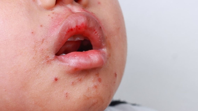 Cần theo dõi các dấu hiệu, hình ảnh ở trẻ để phát hiện sớm khi bệnh chuyển cấp độ