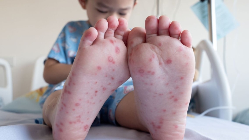 Trẻ bị tay chân miệng cần có chế độ ăn uống phù hợp