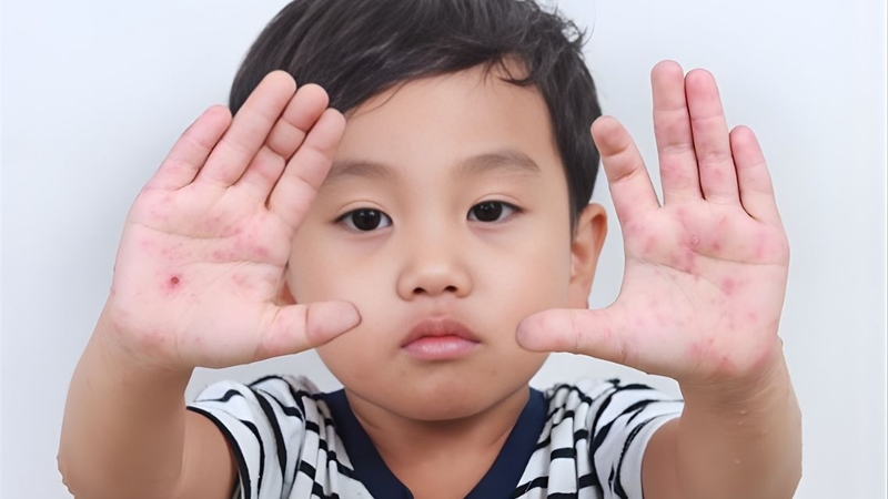 Khi được chăm sóc đúng cách, trẻ bị tay chân miệng sẽ nhanh phục hồi