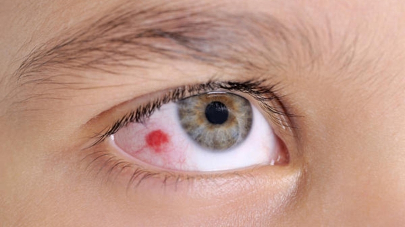 Chấn thương đụng dập nhãn cầu nguy hiểm như thế nào 1
