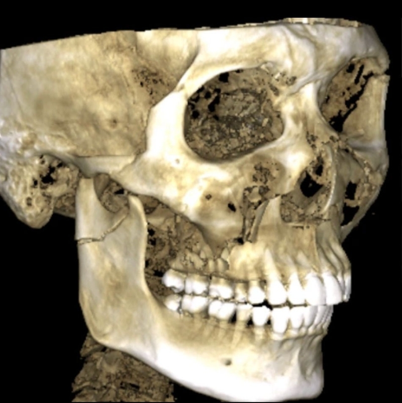 Chấn thương hàm mặt: Phân loại chấn thương và cách xử trí 1