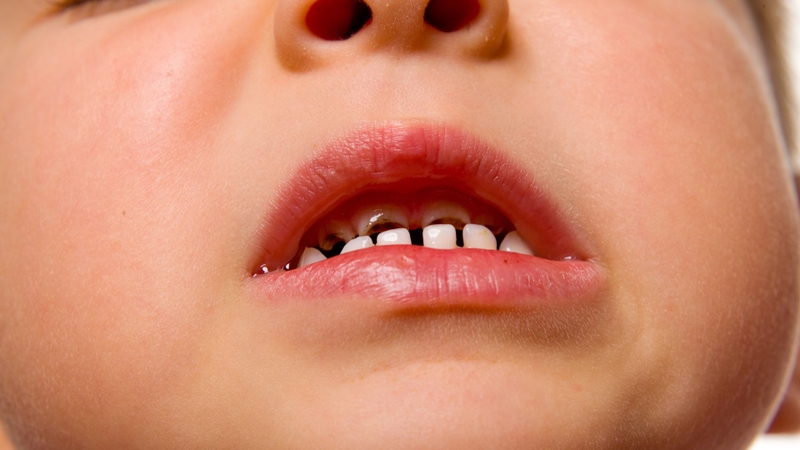 Chấn thương miệng là thuật ngữ chỉ những tổn thương xảy ra trong khoang miệng, bao gồm môi, má, lưỡi, nướu và các cấu trúc liên quan