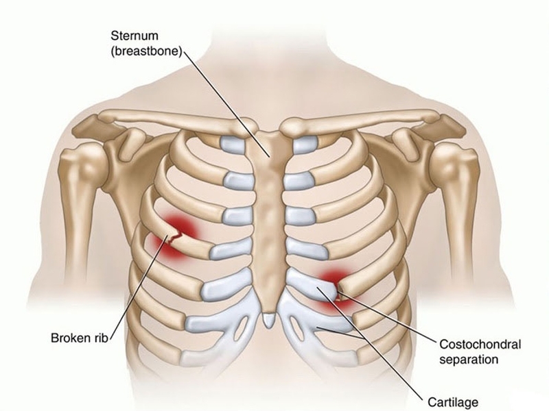 Chấn thương ngực kín và các điều cần biết -1