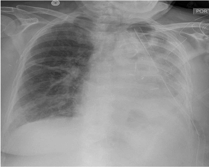 Chấn thương ngực kín và các điều cần biết -3