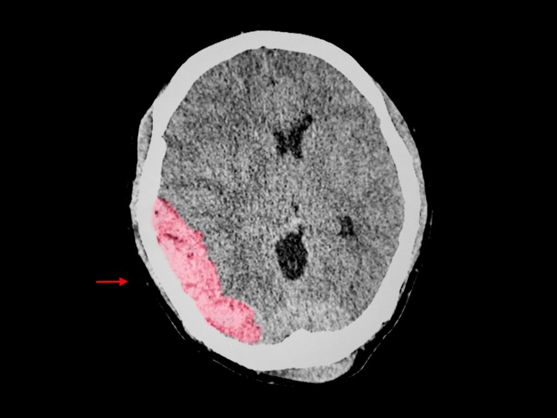 Chấn thương sọ não bao lâu thì hồi phục? Điều trị chấn thương sọ não như thế nào? 2