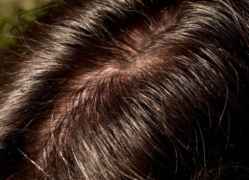 Chân tóc là gì? Chân tóc ở đâu? Nguyên nhân rụng chân tóc và cách khắc phục 1