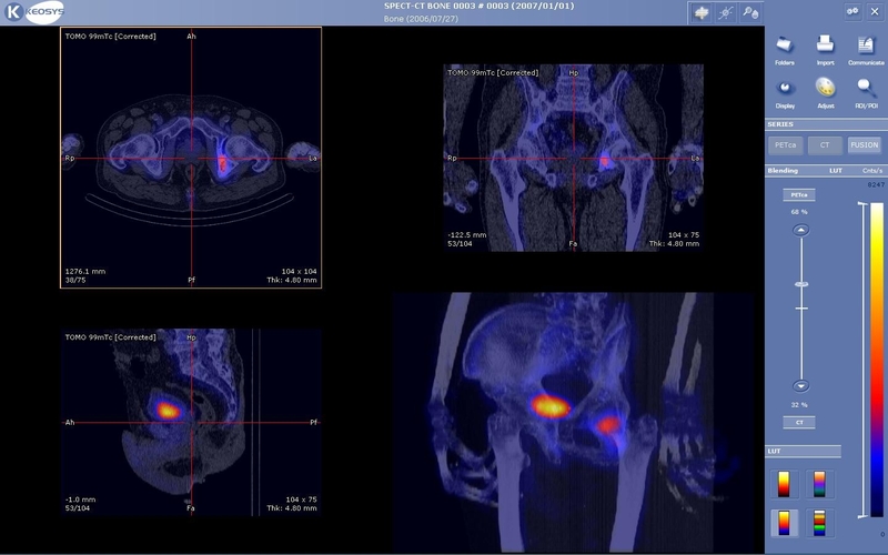 Chất phóng xạ gây ung thư khi nào? Phương pháp điều trị ung thư bằng dược chất phóng xạ 2