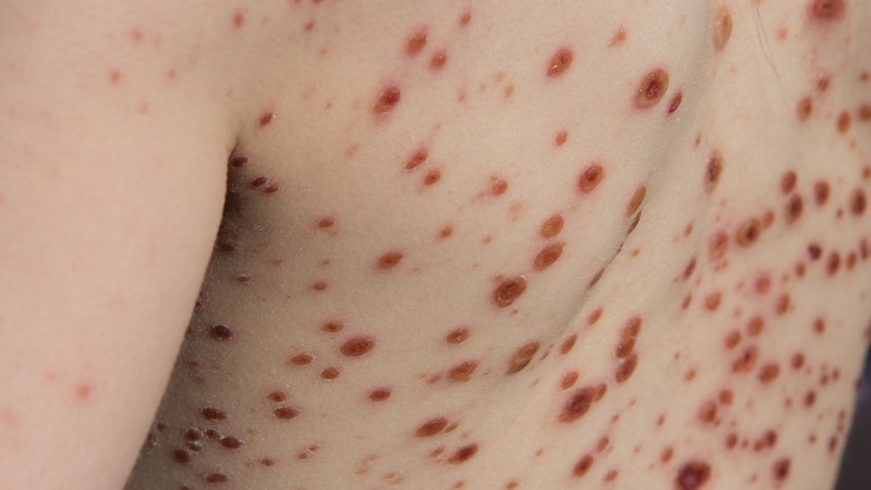 Chạy hậu thủy đậu là gì? Đây không phải một chẩn đoán y khoa cụ thể