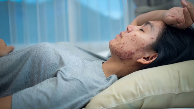 Nhiễm khuẩn thứ phát có thể khiến vùng da tổn thương sưng đỏ, đau và chảy mủ
