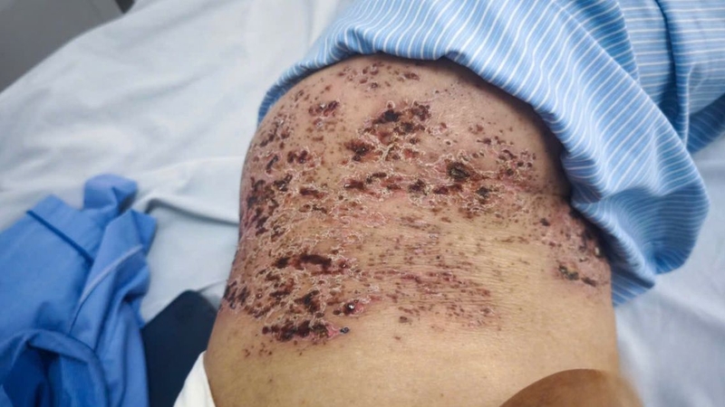 Các nốt thủy đậu khô và bong vảy trong giai đoạn hồi phục