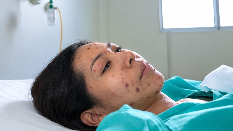 Một số biến chứng sau thủy đậu có thể ảnh hưởng đến hệ thần kinh