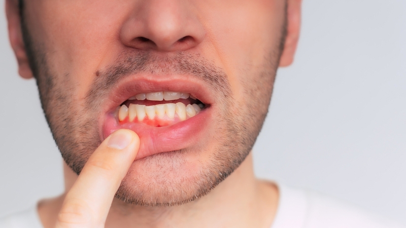 Chảy máu chân răng thường liên quan trực tiếp đến các bệnh lý nướu như viêm nướu và viêm nha chu
