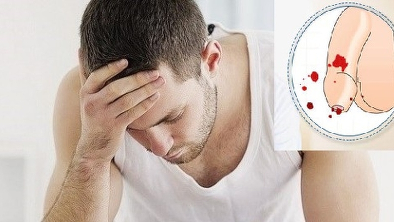 Chảy máu dương vật ở nam giới có sao không? Nguyên nhân và cách xử lý 1