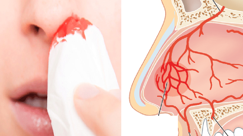 Chảy máu mũi nên làm gì? Nguyên nhân chảy máu mũi do đâu 2