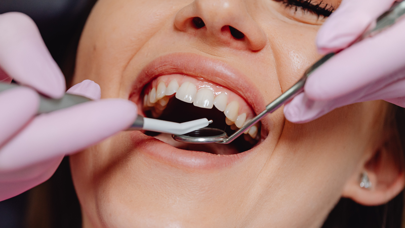 Lấy cao răng định kỳ giúp cải thiện tình trạng chảy máu chân răng