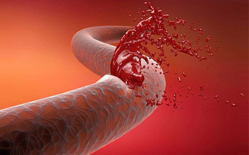 Chảy máu tĩnh mạch có đặc điểm gì? Cách sơ cứu khi gặp chảy máu tĩnh mạch 1