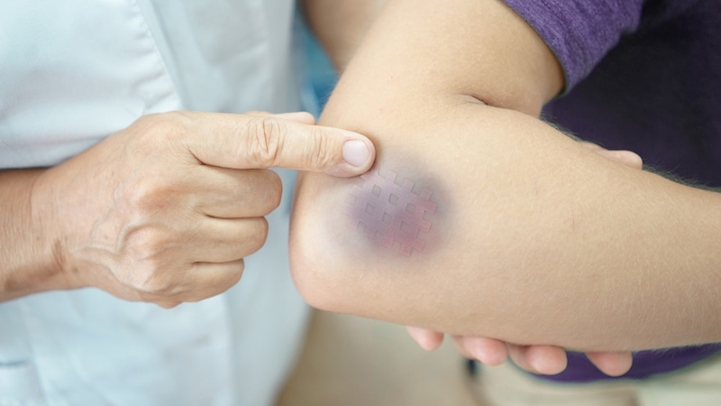 Chảy máu trong là gì? Nguyên nhân, triệu chứng của chảy máu trong 3