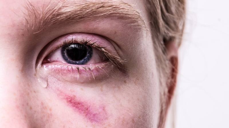 Chảy máu trong là gì? Nguyên nhân, triệu chứng của chảy máu trong 2