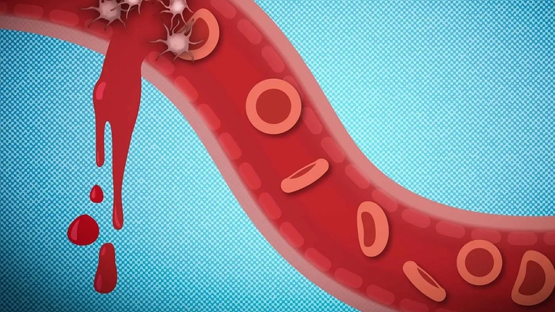 Chảy máu trong là gì? Nguyên nhân, triệu chứng của chảy máu trong 1