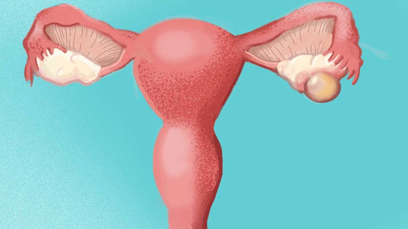 Chảy máu trong ổ bụng không do chấn thương: Chẩn đoán, điều trị 2