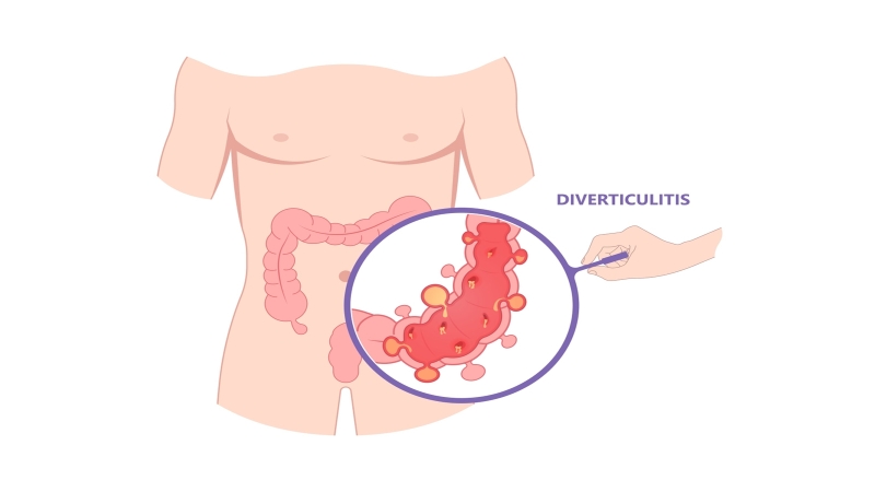 Chảy máu túi thừa đại tràng: Triệu chứng và cách điều trị 1