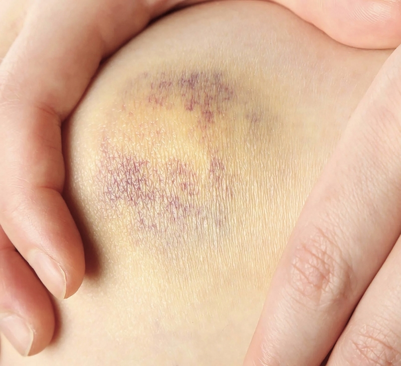 Chảy máu và các mảng bầm tím trong điều trị ung thư1