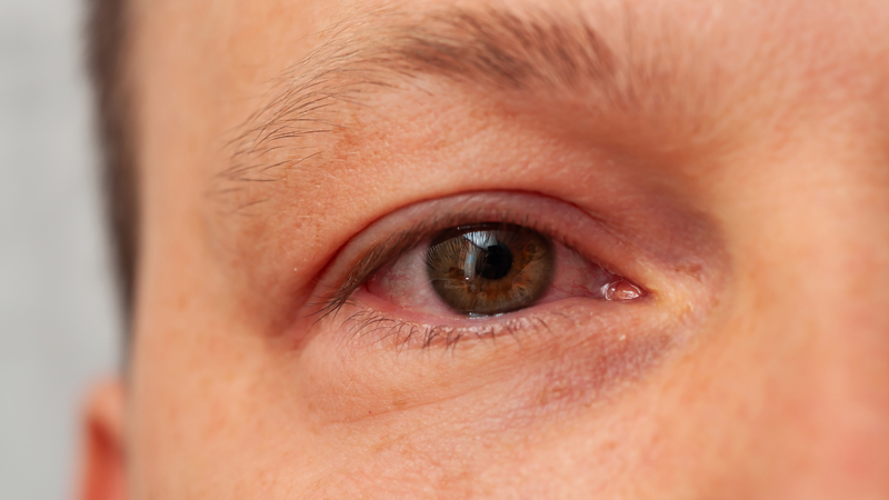 Dị ứng mắt gây chảy nước mắt sống