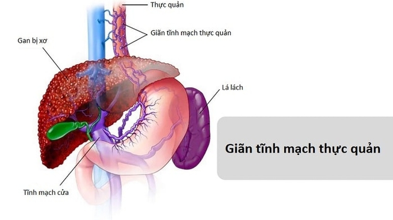 Chế độ ăn cho người giãn tĩnh mạch thực quản: Nên ăn gì, kiêng gì? 1