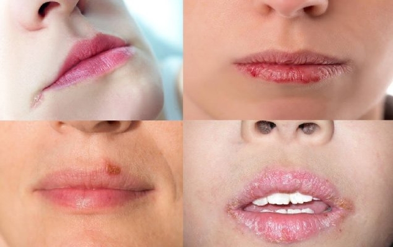 Chế độ ăn uống điều độ khi mắc bệnh chốc mép vào mùa Đông