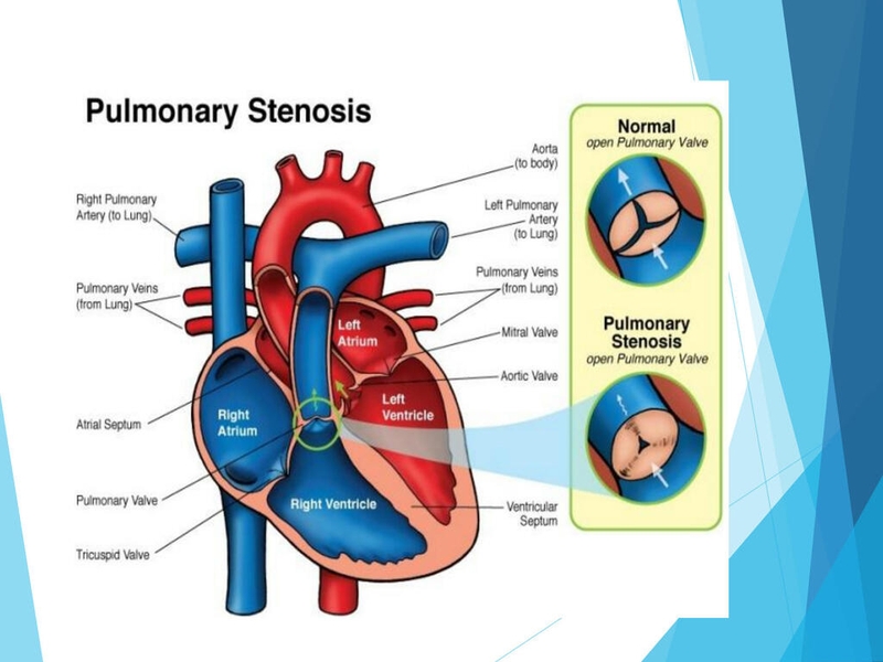 Chỉ định và chống chỉ định của phương pháp nong van động mạch phổi 1