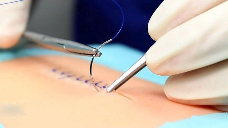 Chỉ khâu tầng sinh môn bao lâu thì tiêu? 2