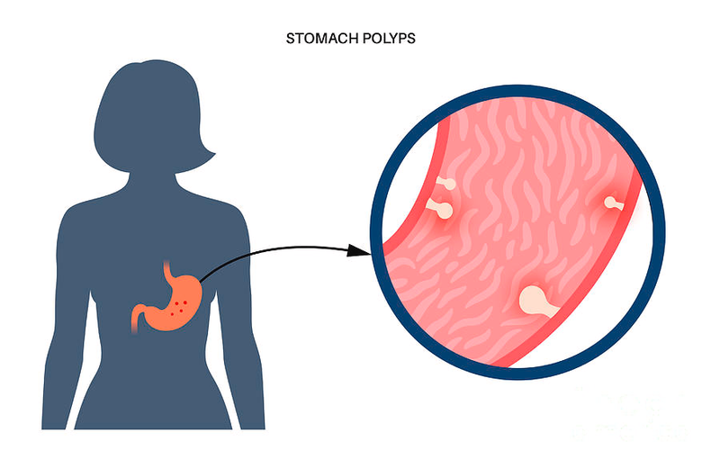 Chi phí cắt polyp dạ dày​ bao nhiêu? Khi nào cần cắt polyp dạ dày?1