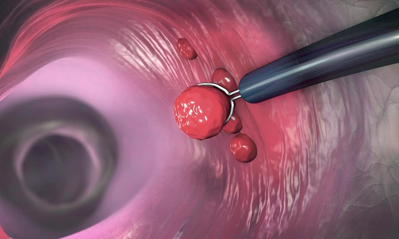 Chi phí cắt polyp dạ dày​ bao nhiêu? Khi nào cần cắt polyp dạ dày?2