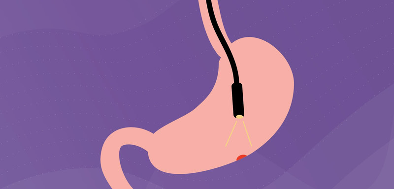 Chi phí cắt polyp dạ dày​ bao nhiêu? Khi nào cần cắt polyp dạ dày?4