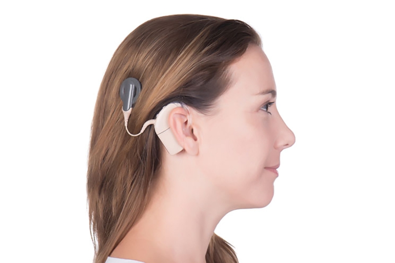 Chi phí cấy ốc tai điện tử khoảng bao nhiêu? Có hiệu quả không? 3