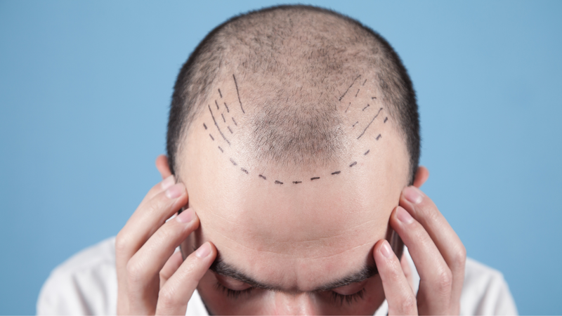 Chi phí cấy tóc bệnh viện da liễu phụ thuộc nhiều yếu tố