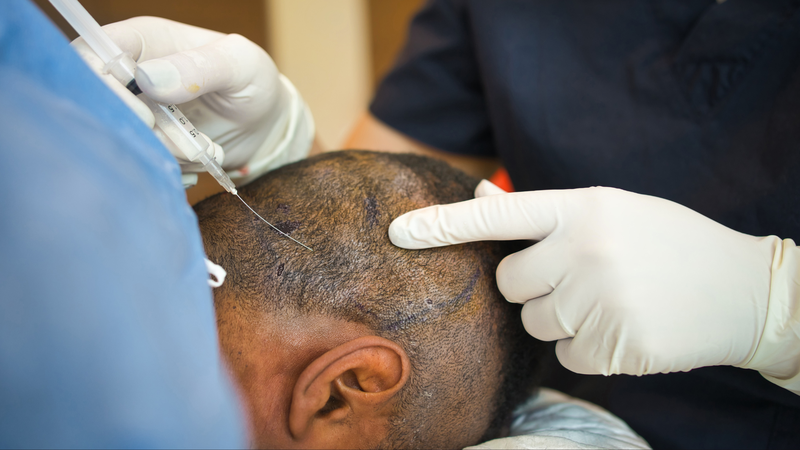 Cấy tóc giá rẻ, không đảm bảo chất lượng có nguy cơ gây nhiễm trùng và sẹo