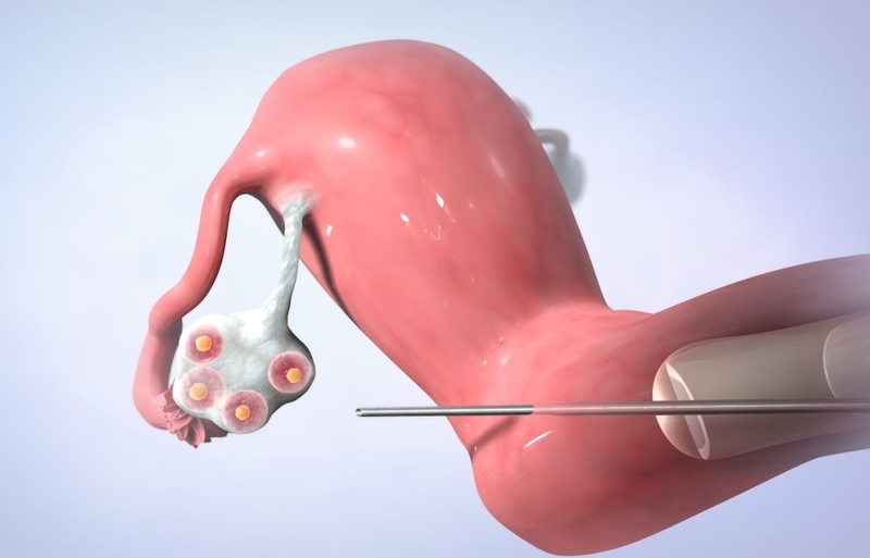 Giải đáp thắc mắc: Chi phí chọc hút trứng hết bao nhiêu tiền 1