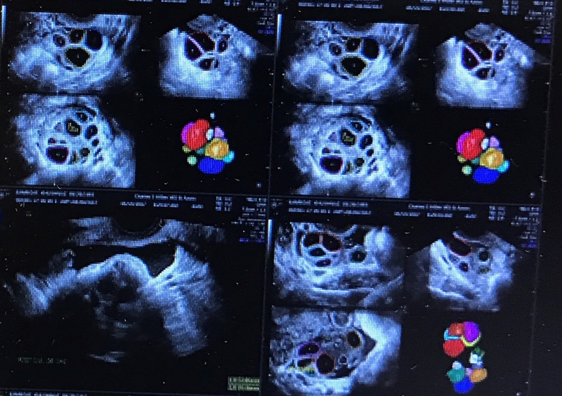 Giải đáp thắc mắc: Chi phí chọc hút trứng hết bao nhiêu tiền 4