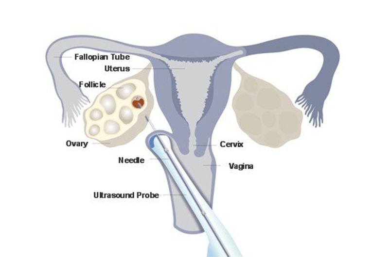 Giải đáp thắc mắc: Chi phí chọc hút trứng hết bao nhiêu tiền 3
